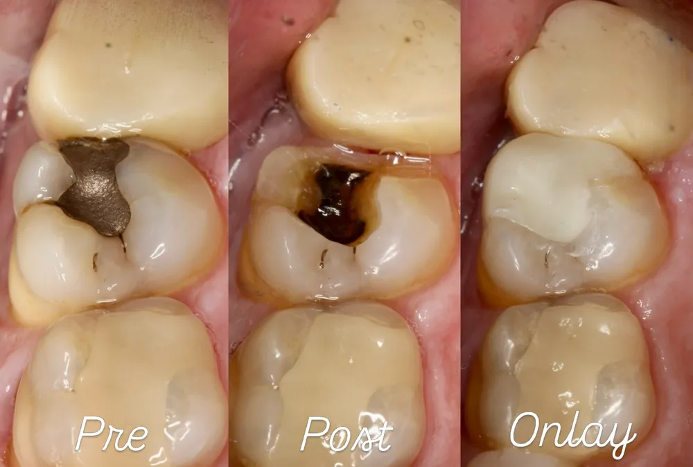 Molar restoration progression