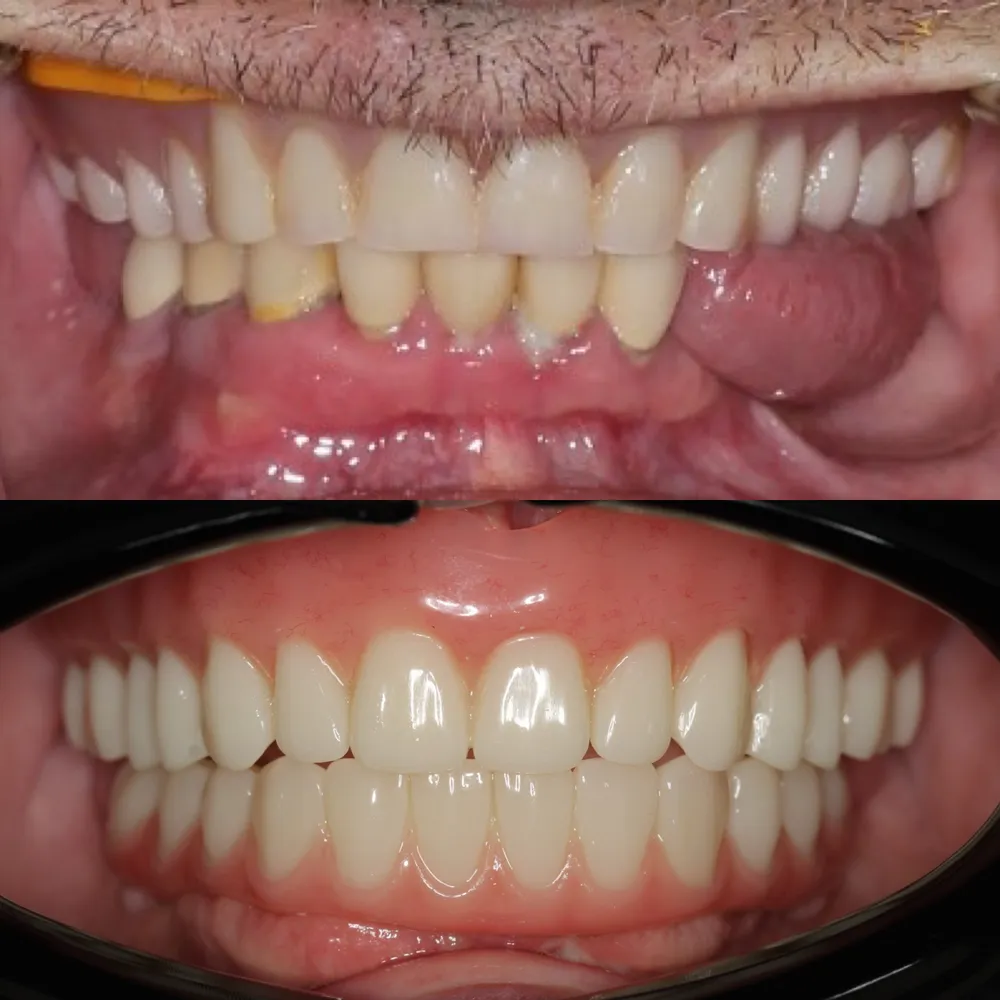 Full-arch dental restoration results