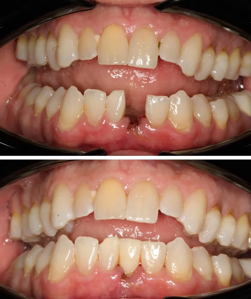 Before and after tooth restoration