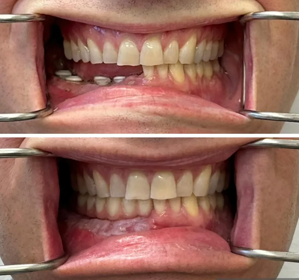 Before and after dental bridge restoration