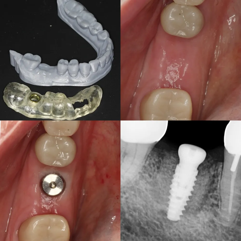 Dental implant process showing surgical guide, intraoral views, and X-ray