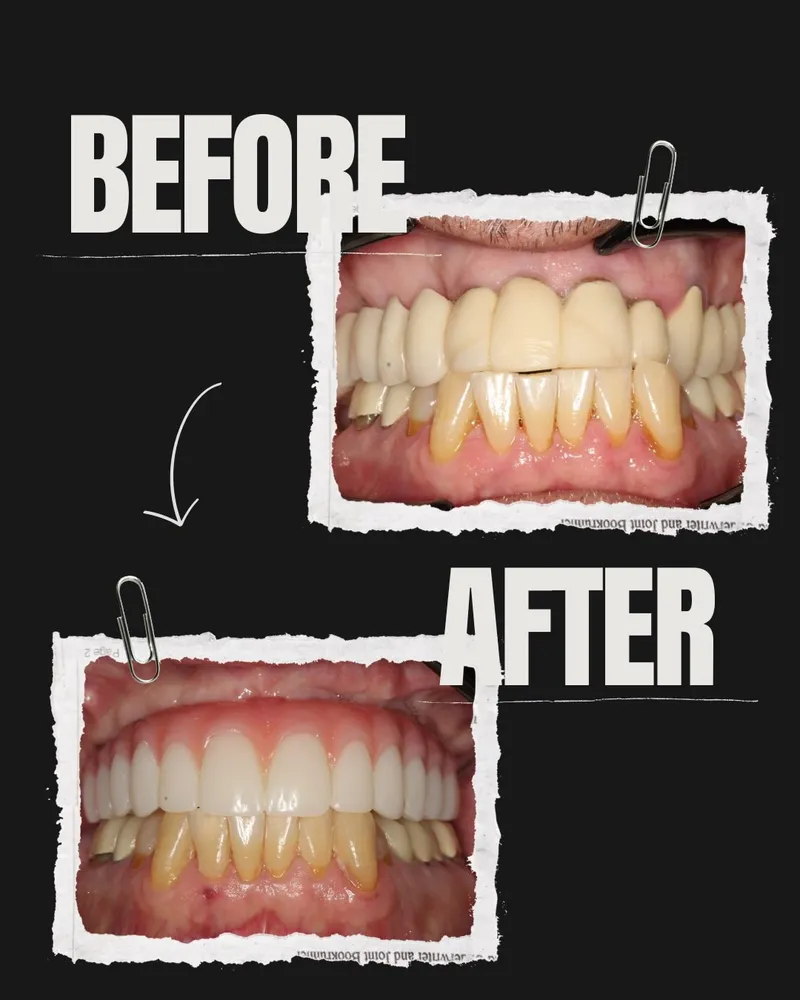 Before and after veneer results