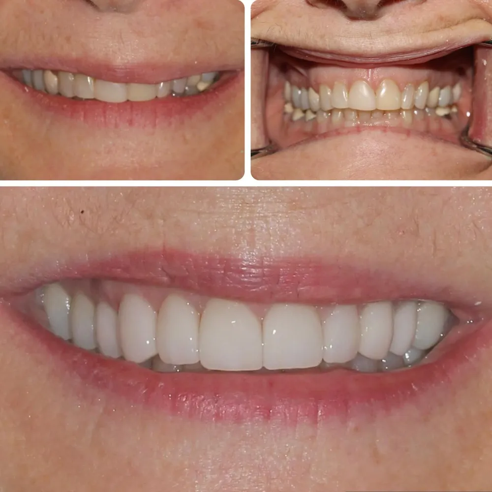 Smile transformation with veneers