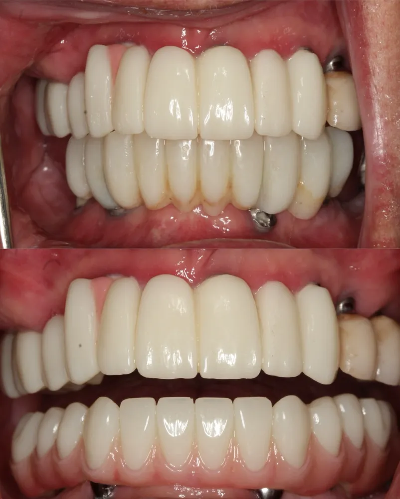 Dental restoration results